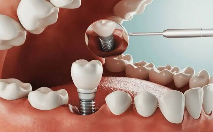 Immediate Load Vs Staged Implants: How Dentists&nbsp;Decide